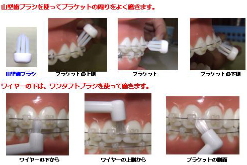 歯科衛生士・髙橋のおすすめ！歯間ブラシのご紹介！ - 院内新聞 横須賀